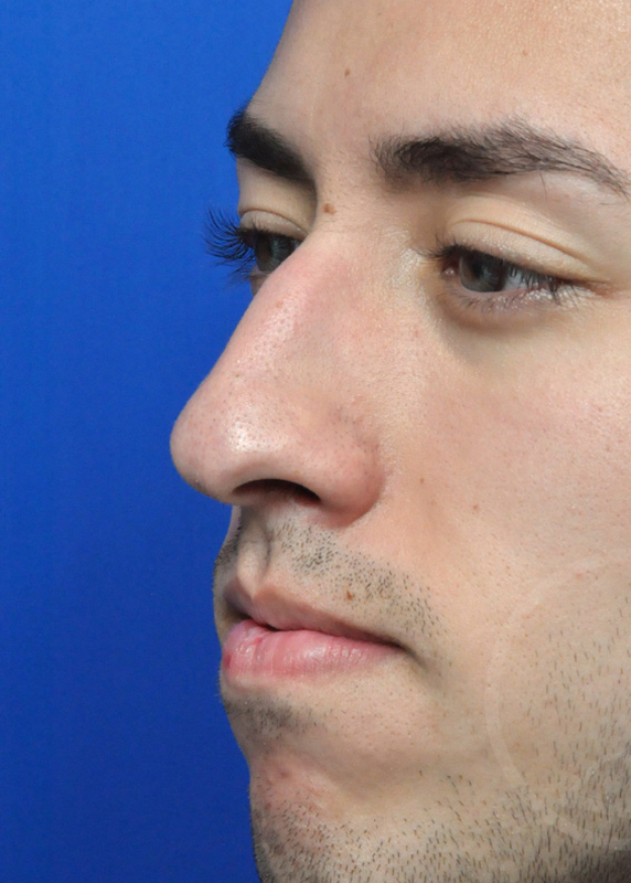 Rhinoplasty Before and After Pictures Jacksonville, FL