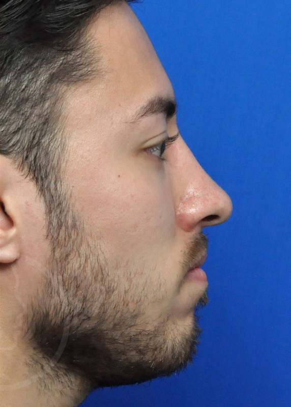 Rhinoplasty Before and After Pictures Jacksonville, FL