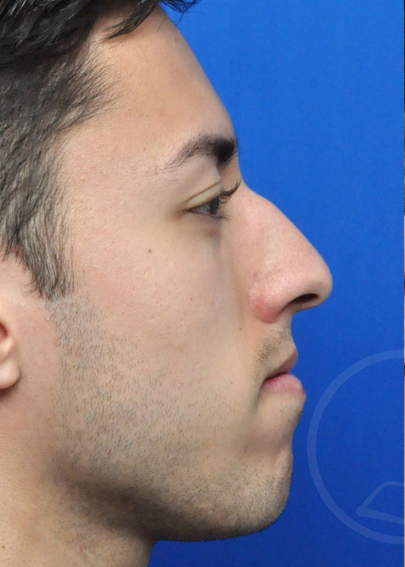 Rhinoplasty Before and After Pictures Jacksonville, FL