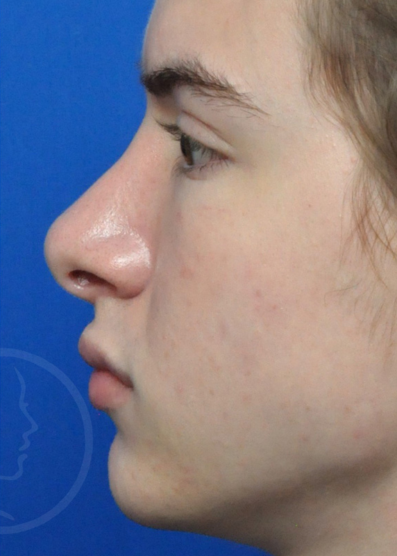 Rhinoplasty Before and After Pictures Jacksonville, FL