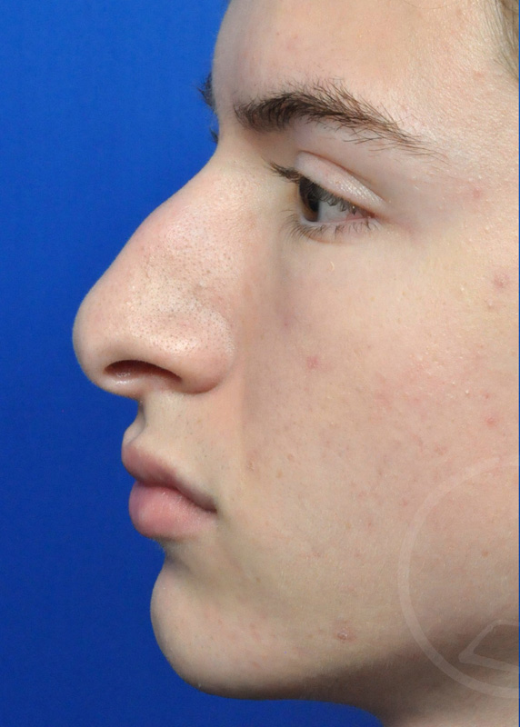 Rhinoplasty Before and After Pictures Jacksonville, FL