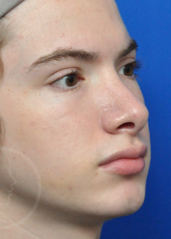 Rhinoplasty Before and After Pictures Jacksonville, FL