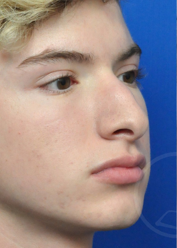 Rhinoplasty Before and After Pictures Jacksonville, FL