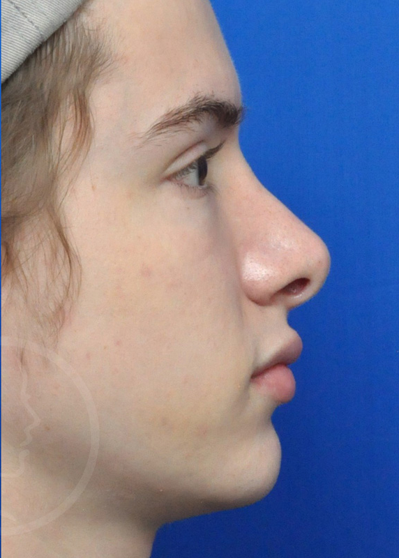 Rhinoplasty Before and After Pictures Jacksonville, FL