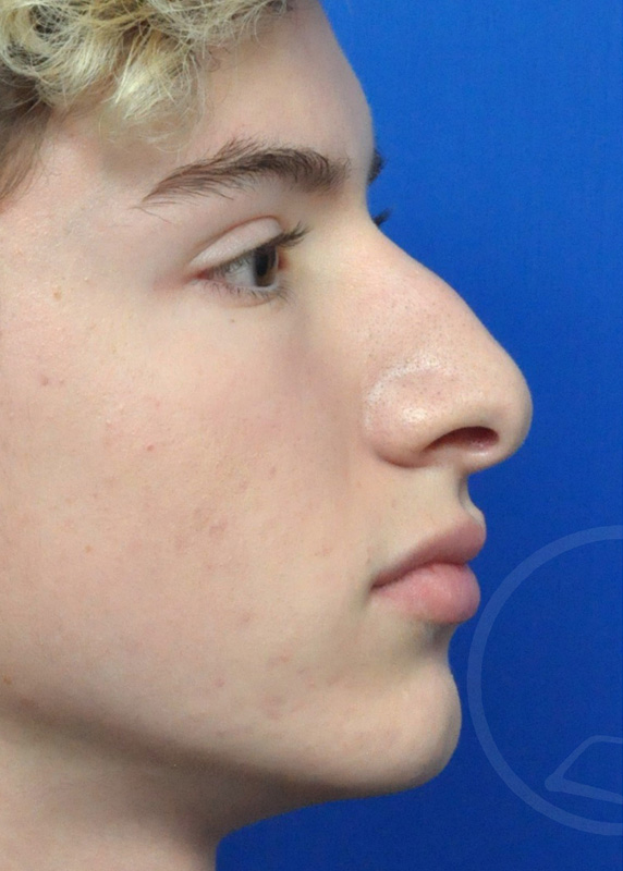 Rhinoplasty Before and After Pictures Jacksonville, FL