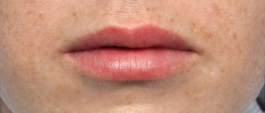 Juvederm Before and After Pictures Jacksonville, FL