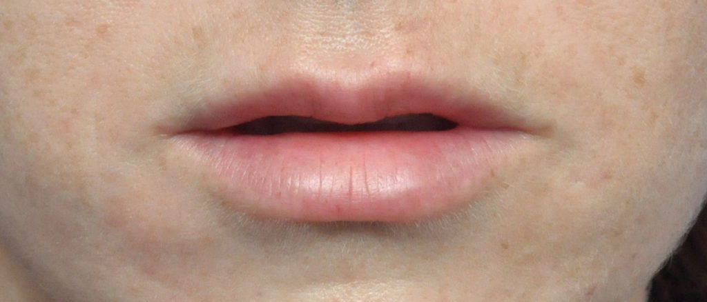 Juvederm Before and After Pictures Jacksonville, FL