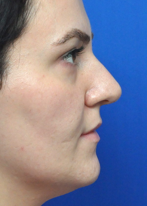 Liquid Rhinoplasty Before and After Pictures in Jacksonville, FL