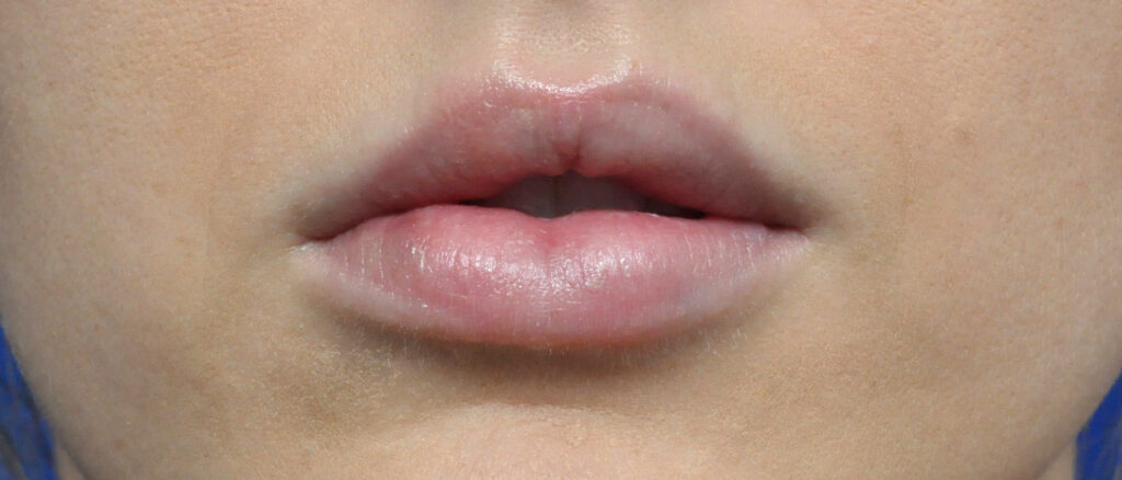 Plastic Surgery Before and After Pictures in Jacksonville, FL - Garcia Facial Plastic Surgery