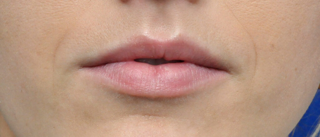 Plastic Surgery Before and After Pictures in Jacksonville, FL - Garcia Facial Plastic Surgery