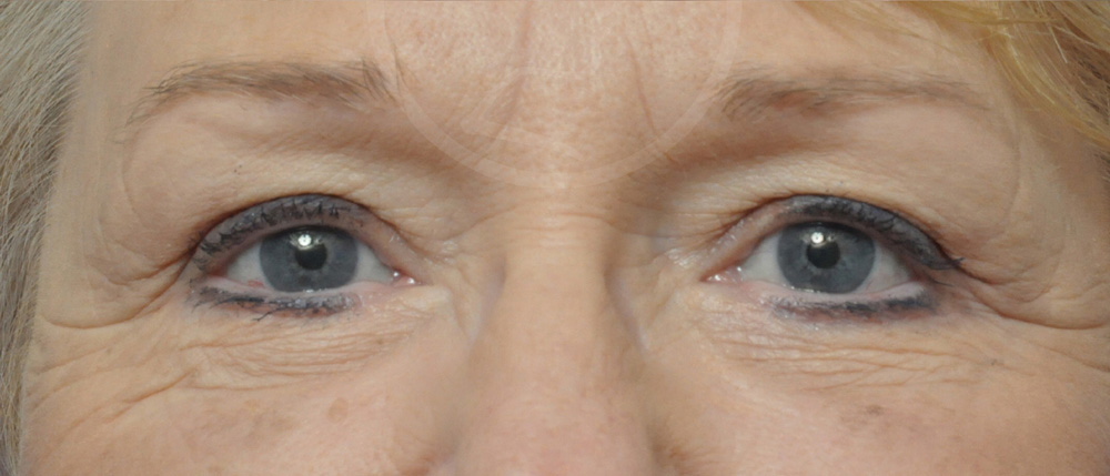 Blepharoplasty Before and After Pictures Jacksonville, FL