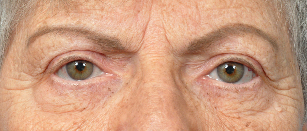 Blepharoplasty Before and After Pictures Jacksonville, FL