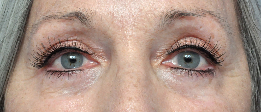 Blepharoplasty Before and After Pictures Jacksonville, FL