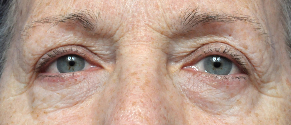 Blepharoplasty Before and After Pictures Jacksonville, FL