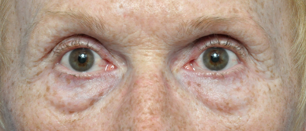 Blepharoplasty Before and After Pictures Jacksonville, FL