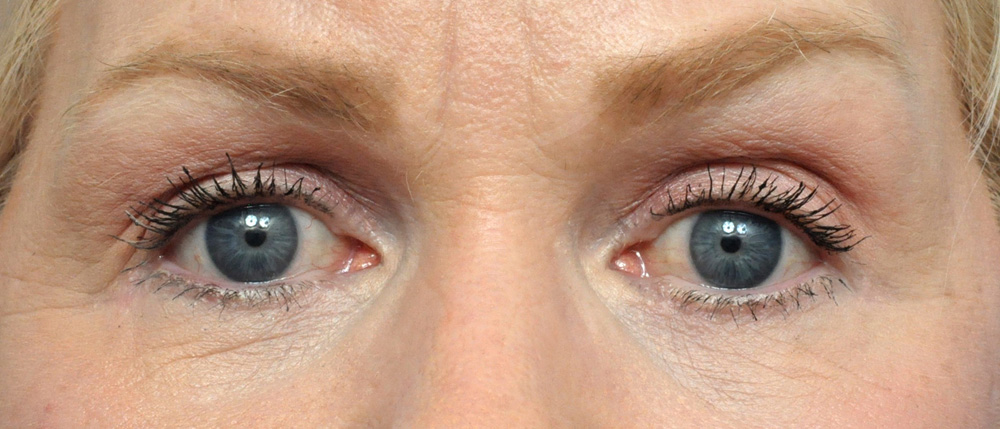 Blepharoplasty Before and After Pictures Jacksonville, FL