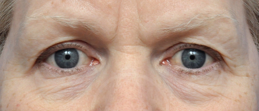 Blepharoplasty Before and After Pictures Jacksonville, FL