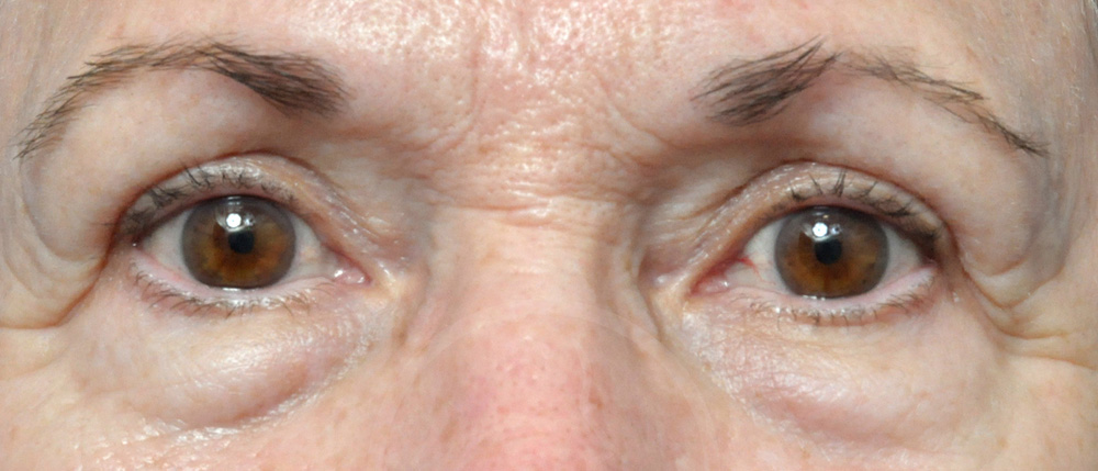 Blepharoplasty Before and After Pictures Jacksonville, FL