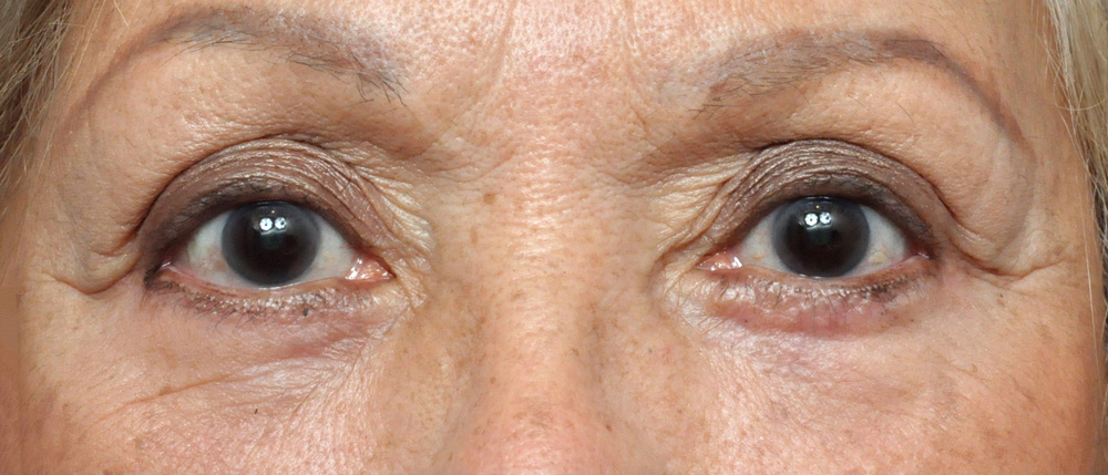 Blepharoplasty Before and After Pictures Jacksonville, FL