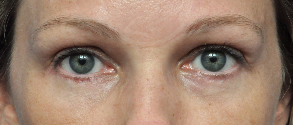 Blepharoplasty Before and After Pictures Jacksonville, FL