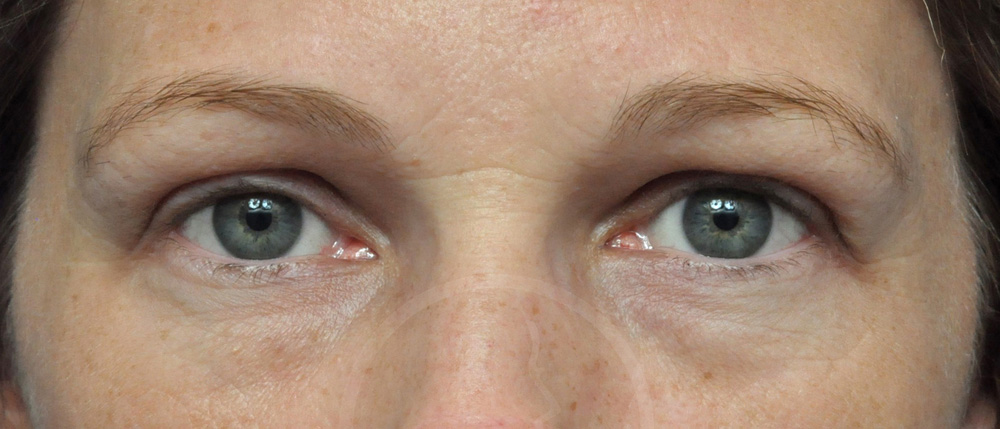 Blepharoplasty Before and After Pictures Jacksonville, FL