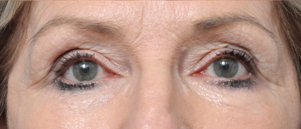 Blepharoplasty Before and After Pictures Jacksonville, FL