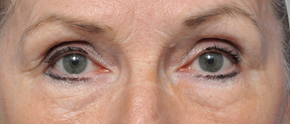 Blepharoplasty Before and After Pictures Jacksonville, FL