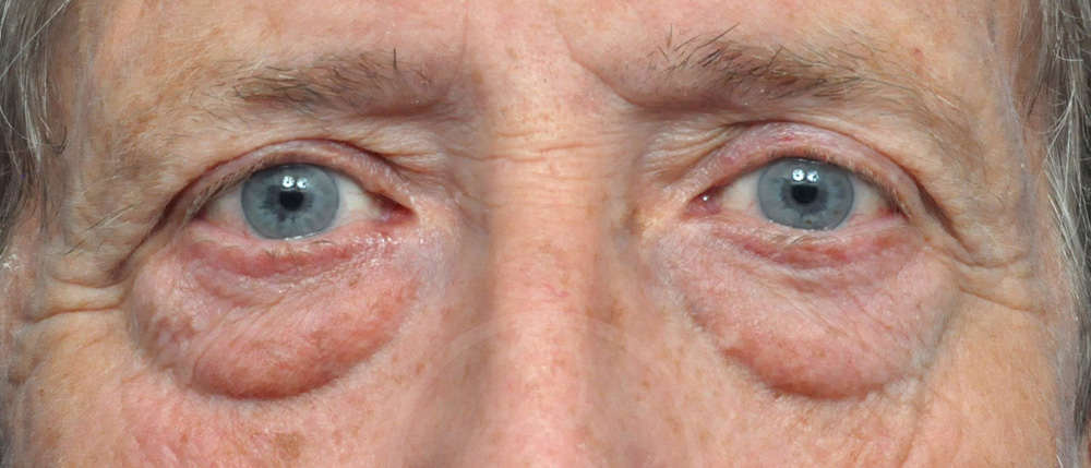 Blepharoplasty Before and After Pictures Jacksonville, FL