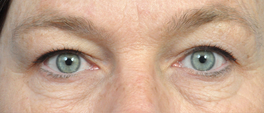 Blepharoplasty Before and After Pictures Jacksonville, FL