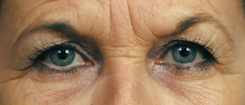 Blepharoplasty Before and After Pictures Jacksonville, FL