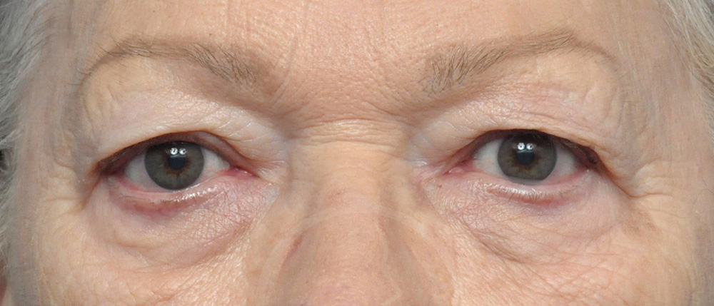 Blepharoplasty Before and After Pictures Jacksonville, FL