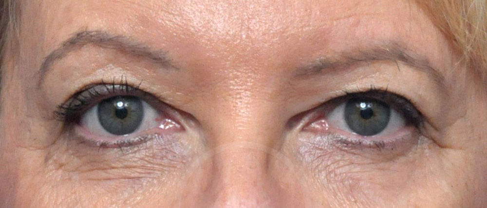 Blepharoplasty Before and After Pictures Jacksonville, FL