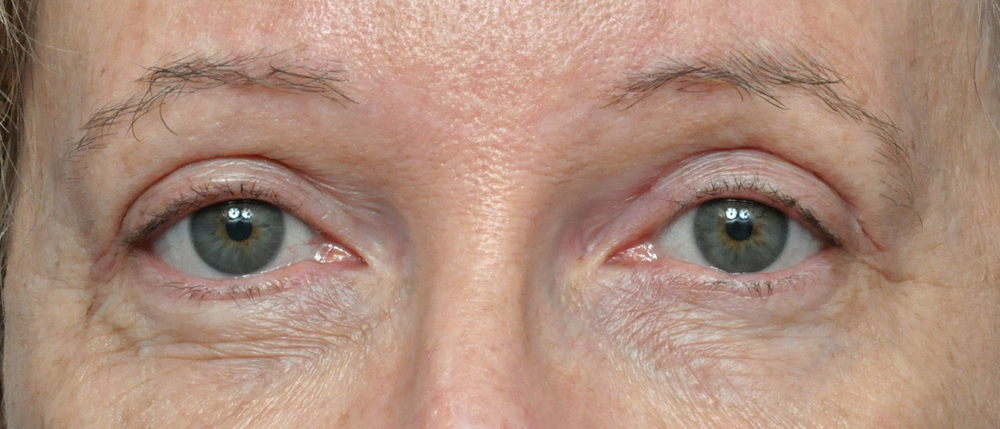 Blepharoplasty Before and After Pictures Jacksonville, FL