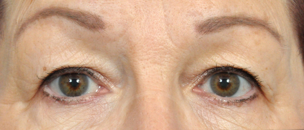 Blepharoplasty Before and After Pictures Jacksonville, FL