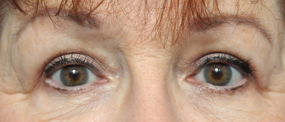 Blepharoplasty Before and After Pictures Jacksonville, FL