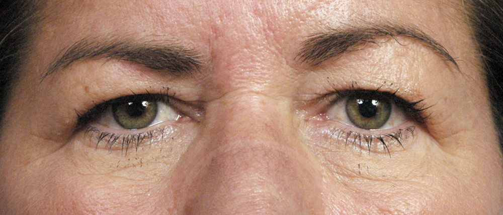 Blepharoplasty Before and After Pictures Jacksonville, FL