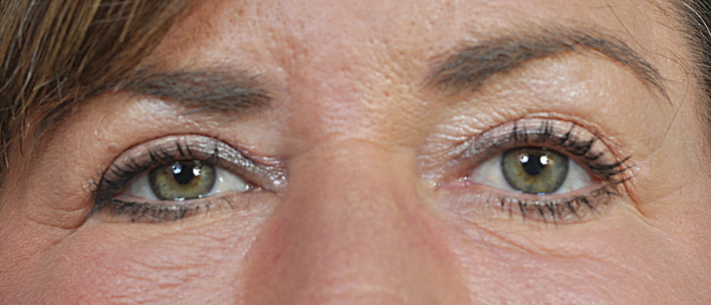 Blepharoplasty Before and After Pictures Jacksonville, FL