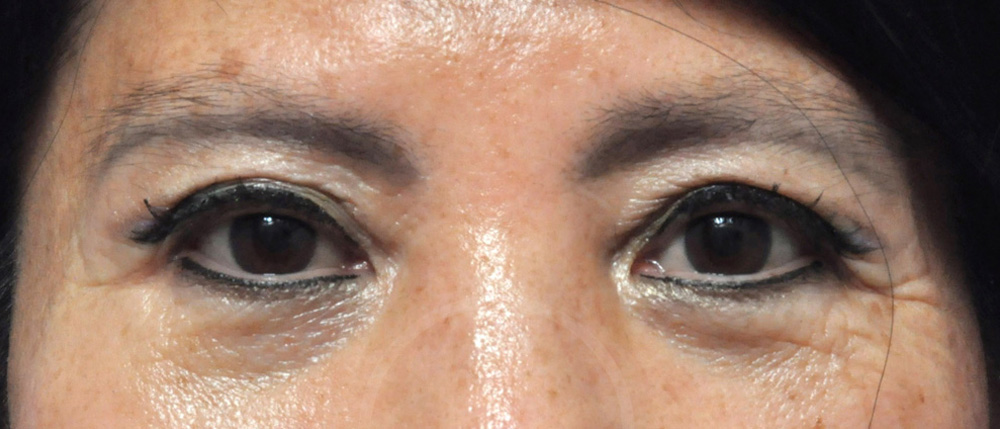 Blepharoplasty Before and After Pictures Jacksonville, FL