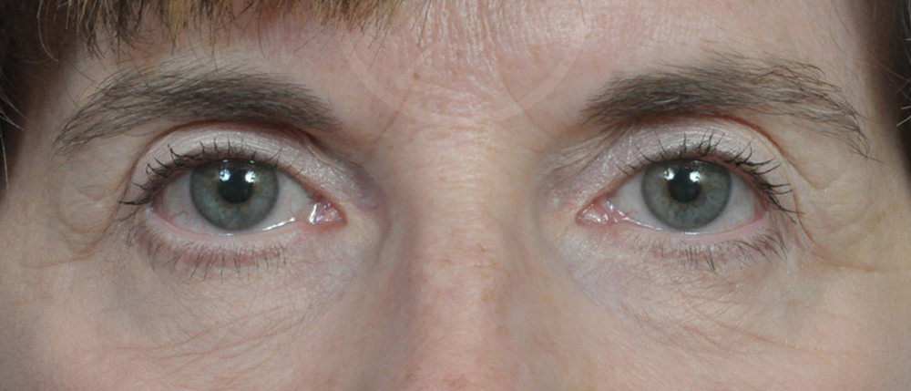 Blepharoplasty Before and After Pictures Jacksonville, FL