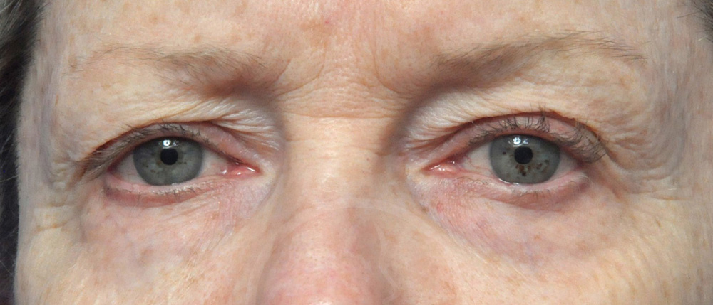 Blepharoplasty Before and After Pictures Jacksonville, FL