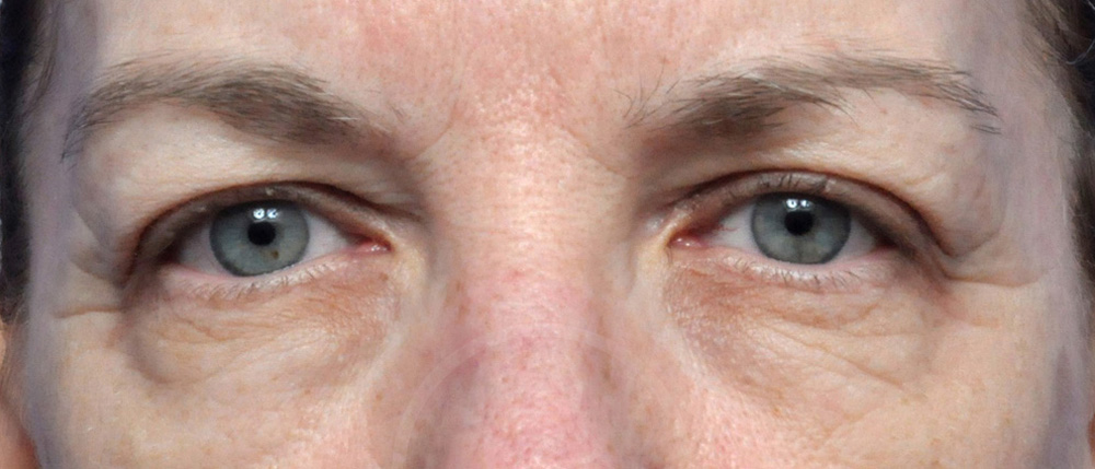 Blepharoplasty Before and After Pictures Jacksonville, FL