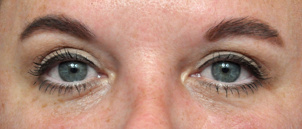 Blepharoplasty Before and After Pictures Jacksonville, FL