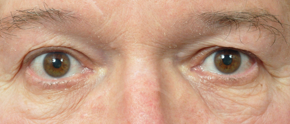 Blepharoplasty Before and After Pictures Jacksonville, FL