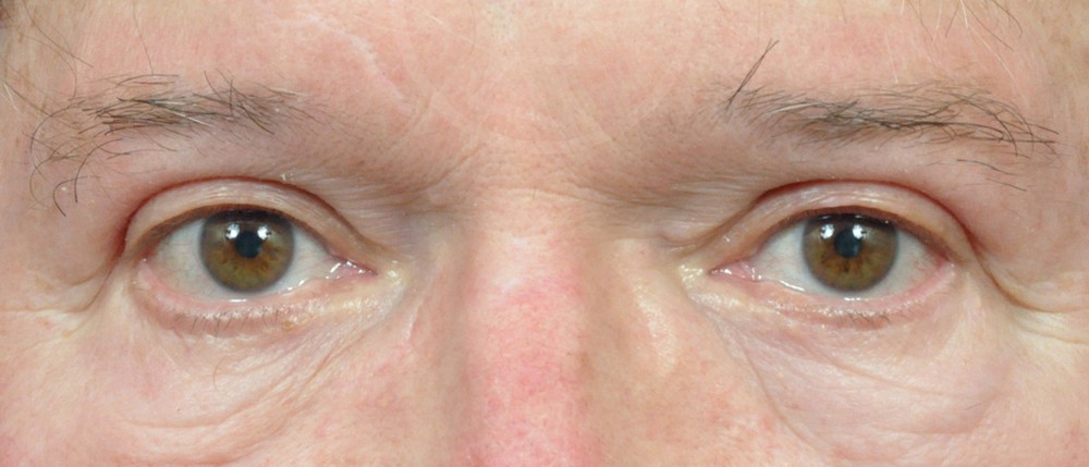 Blepharoplasty Before and After Pictures Jacksonville, FL