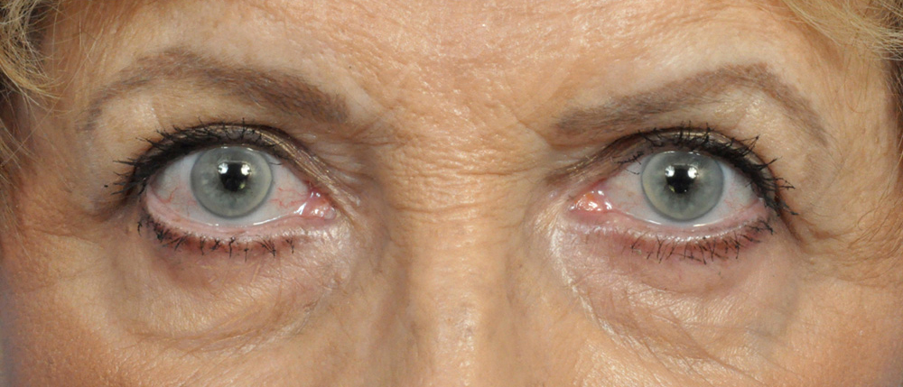 Blepharoplasty Before and After Pictures Jacksonville, FL