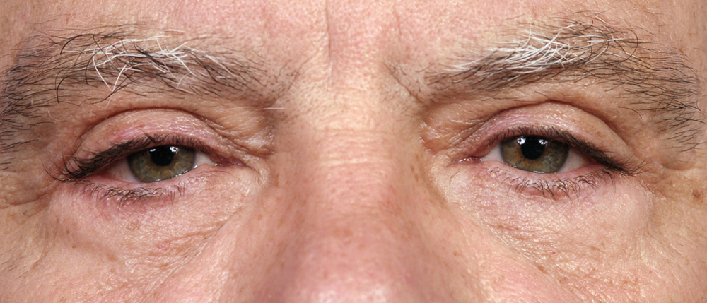 Blepharoplasty Before and After Pictures Jacksonville, FL