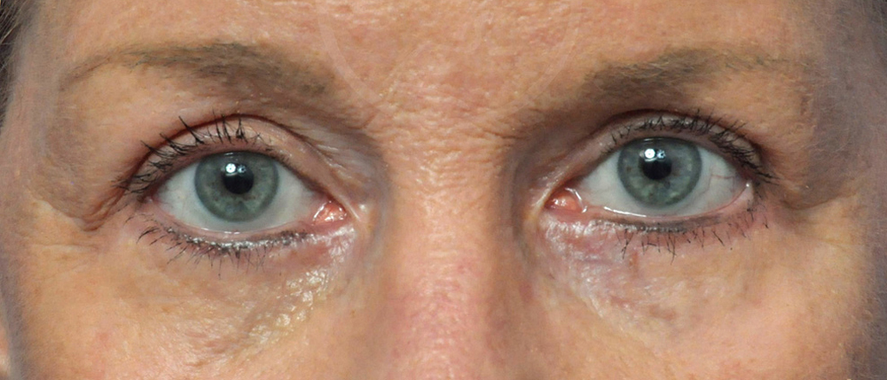 Blepharoplasty Before and After Pictures Jacksonville, FL