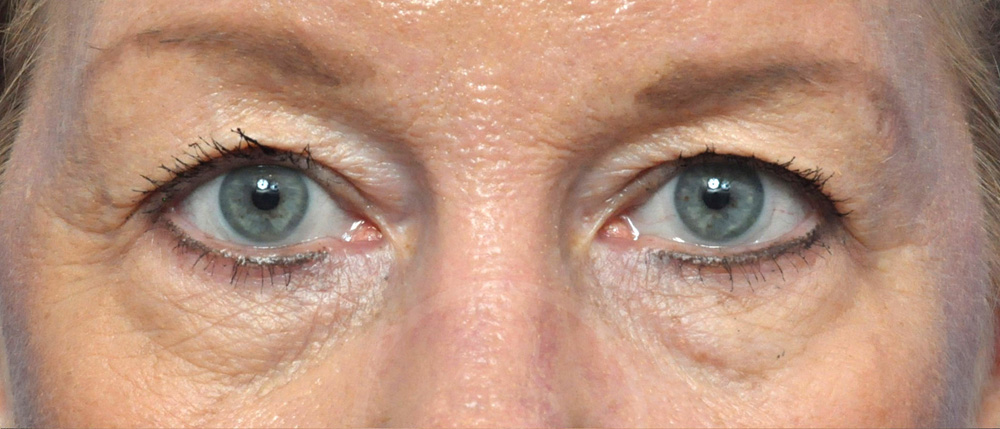 Blepharoplasty Before and After Pictures Jacksonville, FL