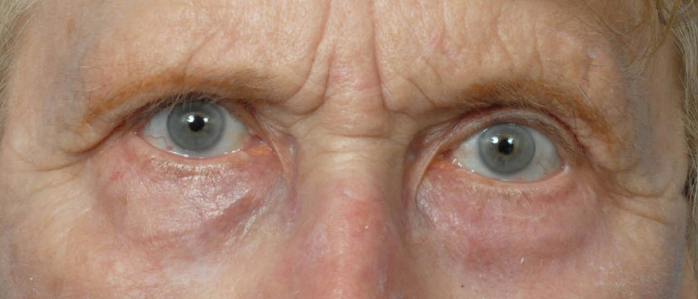 Blepharoplasty Before and After Pictures Jacksonville, FL