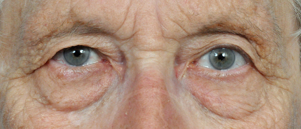 Blepharoplasty Before and After Pictures Jacksonville, FL